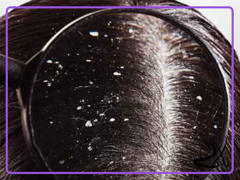 راهکارهای مؤثر برای جلوگیری از شوره سر